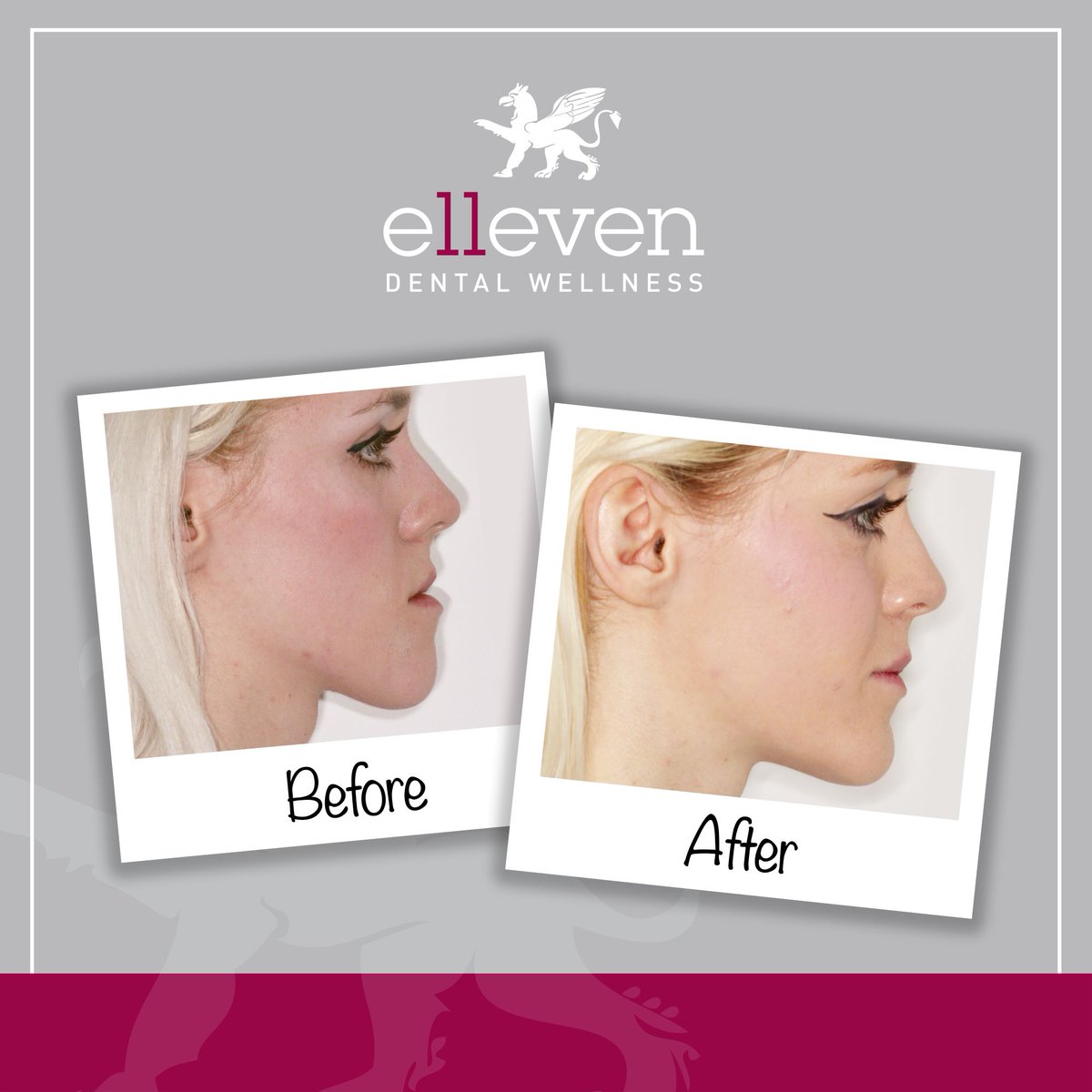 We're believers that #braces have the power to create a beautiful face. The facial &amp; smile enhancement is more powerful, as shown by this #transformation! Get in touch with us while our Summer Smiles offer (£1000 off orthodontic treatment) is still on: ellevendental.com/contact/