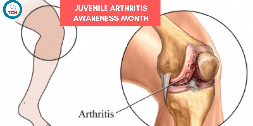 Juvenile idiopathic arthritis, formally known as juvenile rheumatoid arthritis, is the most common type of arthritis in children under the age of 16. Juvenile idiopathic arthritis can be caused by persistent joint pain, swelling and stiffness.