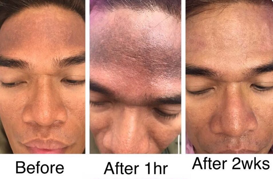 InmodeUK's tweet image. Check out this before and after for pigmentation on the forehead with our Lumecca IPL treatment by Dr Taura Tyrer.
#Repost #care4uk88t ・・・
Lumecca treatment treating dark pigmentation / stubborn discolouration of the skin. Results in just two weeks after treatment.
#tooting