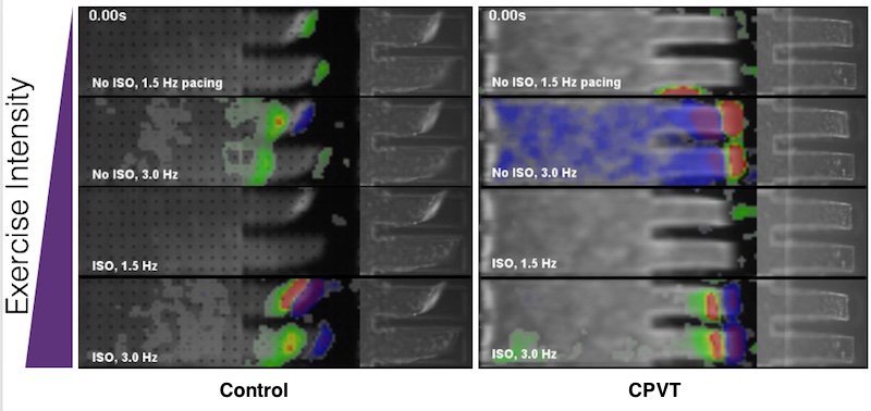 BCH_Innovation's tweet photo. Exercise test in a dish: Patient-specific tissue models suggest a new gene therapy for a heart arrhythmia: https://t.co/nDRca4x7Oo #organsonchips #iPSC #cardiology https://t.co/fleqCHofBh