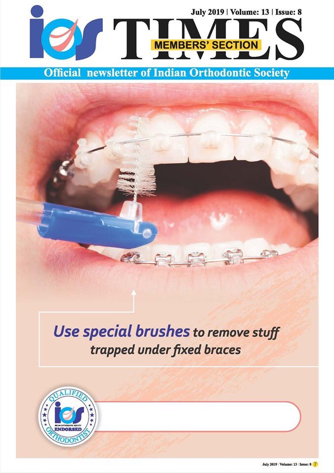 IOSTIMESNEWS's tweet photo. For the layman, food particles stuck around the braces, teeth and gums is simply unsightly. However, not cleaning teeth and gums while undergoing orthodontic treatment has serious repercussions. 
#braces #orthodontist #iostimes #orthodontics #iosembrace https://t.co/OEF6z9bJgY