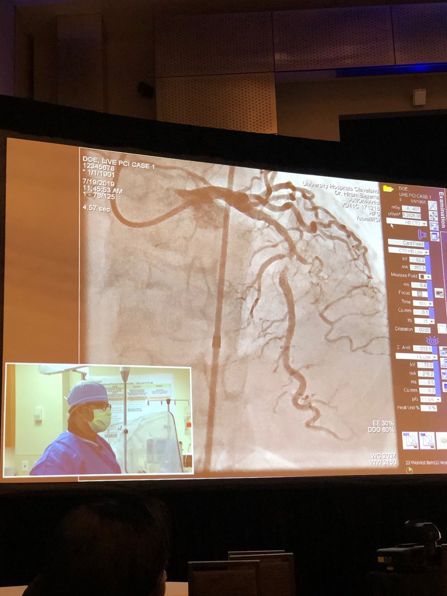 FarshadForouz's tweet image. Great complex calcified mLAD lesion treated with #rotablation and awesome use of #OCT before and after stenting by Dr Bezerra in a live Case from ⁦@UHhospitals⁩ ⁦@cvinnovations⁩ ⁦@shishem⁩