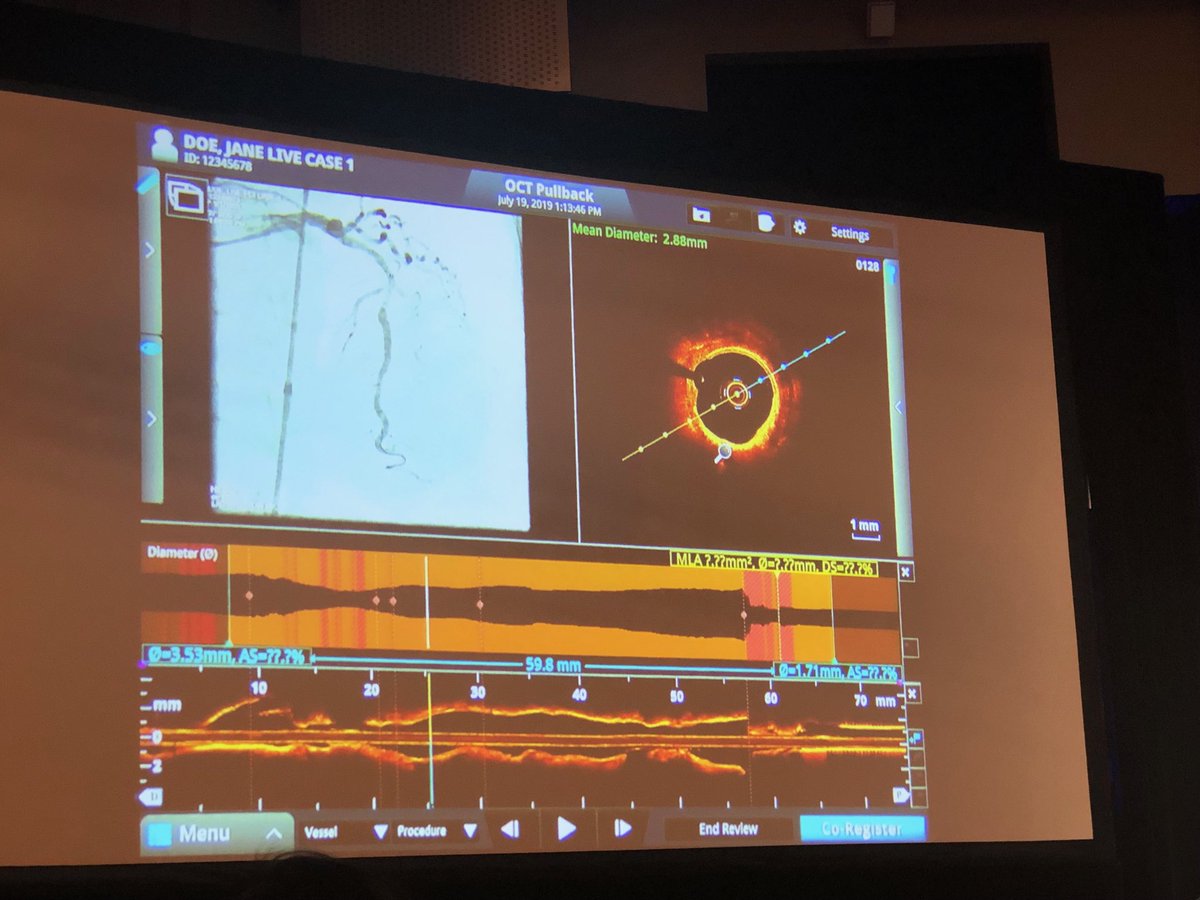 FarshadForouz's tweet image. Great complex calcified mLAD lesion treated with #rotablation and awesome use of #OCT before and after stenting by Dr Bezerra in a live Case from ⁦@UHhospitals⁩ ⁦@cvinnovations⁩ ⁦@shishem⁩