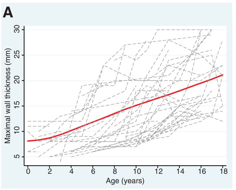 Circulation (@circaha) on Twitter photo At what age should we start screening for #HCM in child 1st degree relatives? New study suggests that it should begin at a younger age. Read more: ow.ly/iCCX50v33Ne | #AHAJournals <a href="/GreatOrmondSt/">Great Ormond Street Hospital for Children</a> At what age should we start screening for #HCM in child 1st degree relatives? New study suggests that it should begin at a younger age. Read more: ow.ly/iCCX50v33Ne | #AHAJournals <a href="/GreatOrmondSt/">Great Ormond Street Hospital for Children</a>