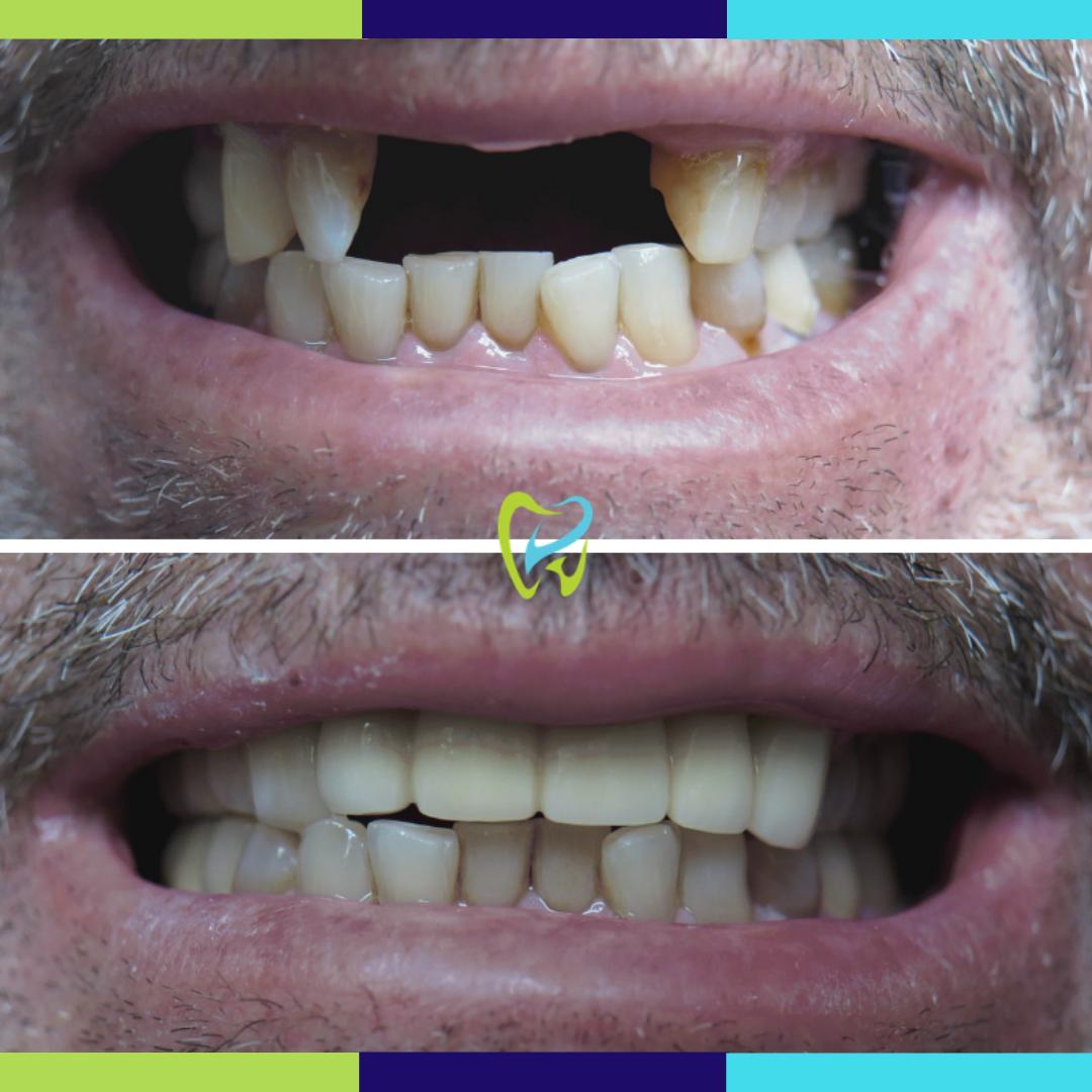 Need Dental Implants to complete your smile? We can help! Learn more about our Dental Implants: dentistoftorrance.com/dental-implant… 

(310) 773-5971
dentistoftorrance.com
