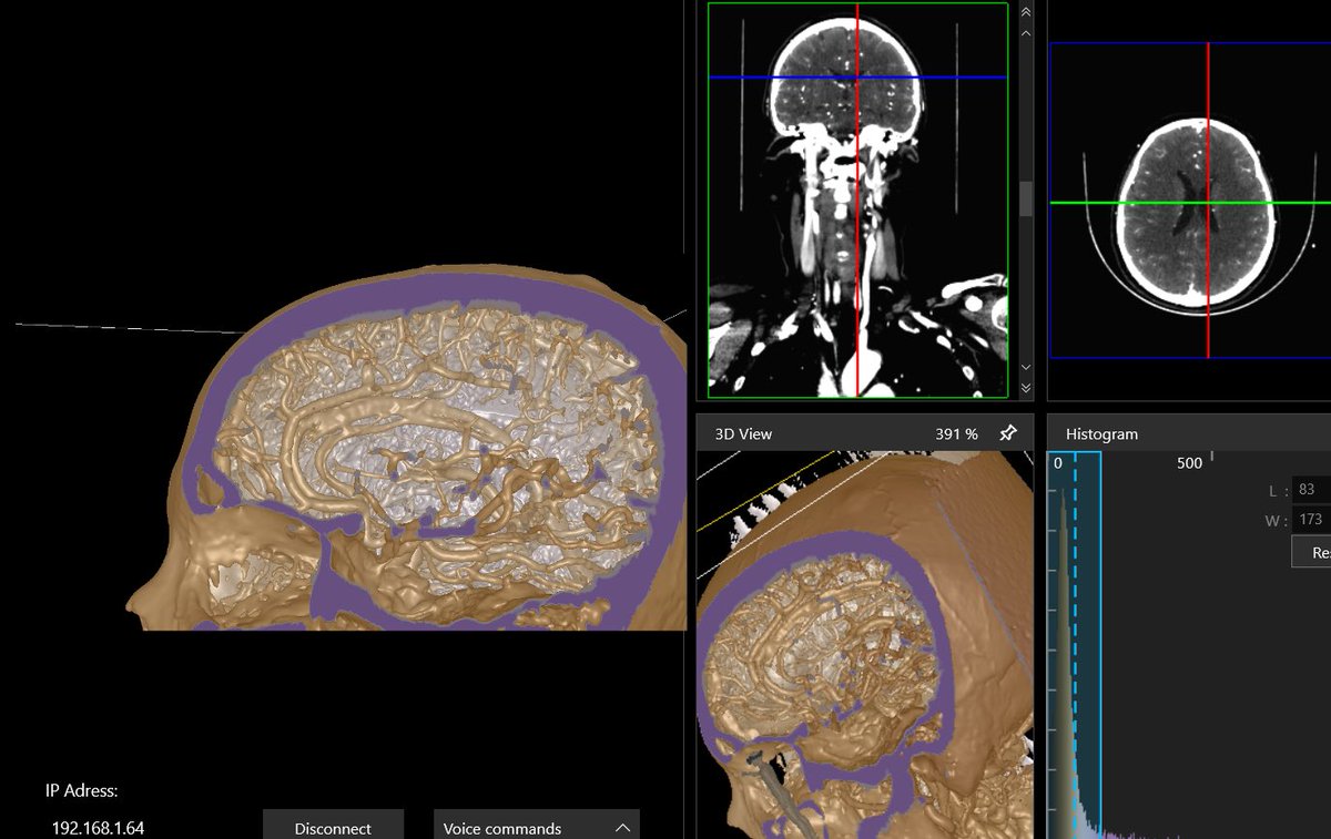 Brain vessels in #ar #hololens #brain ⁦<a href="/Microsoft/">Microsoft</a>⁩ #directx #GPU #UWP #Medicaldevices #ct
