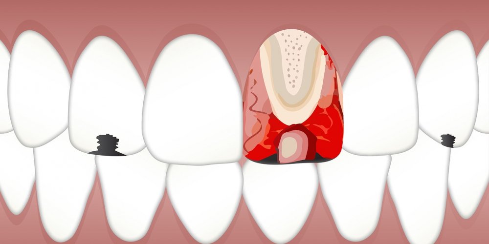 Dentist1pune's tweet image. #dental #pulpitis #whitehttps://www.dentist-pune.com #dentistpune #smilecare #pune #dentist #teeth #braces #smile #dentistfacts #orthodontist