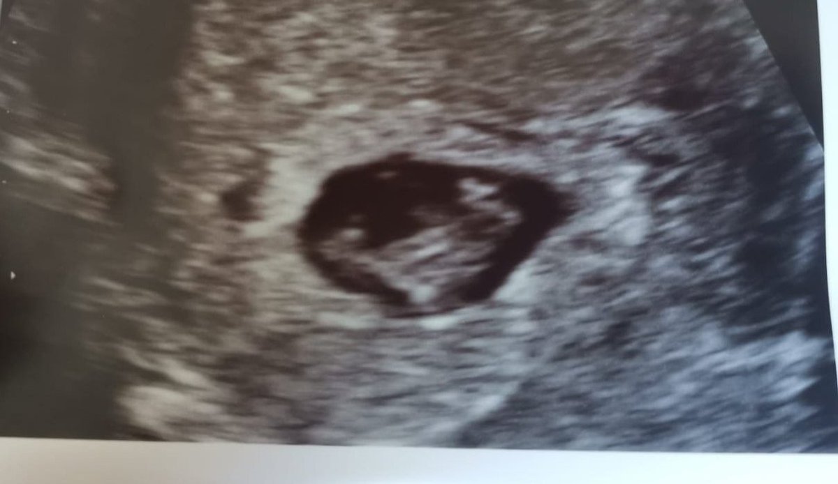 Unfruitful13's tweet photo. #7w4d So relieved, #embryo11 is still growing correctly for our dates and there was a heartbeat. Cramping still there, but they couldn't find a reason for us to be worried today. #infertility #pregnancyafterloss #onedayatatime #hanginthere https://t.co/uh2wpUQMHf