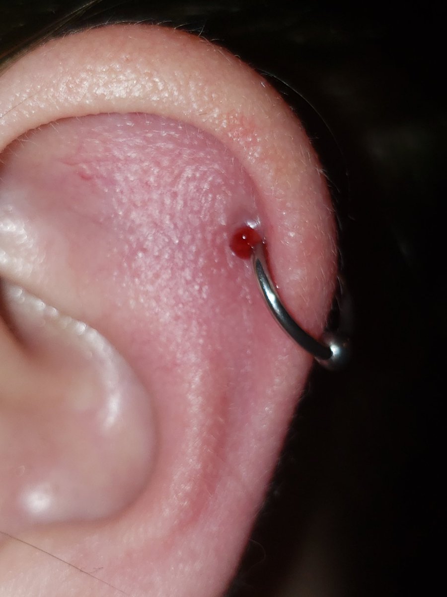 Berryb0x's tweet photo. Hi peircing help?? I've had this piercing for about 8 weeks and this just showed up, it doesnt hurt, but its bleeding some. Can anyone help me out on how to treat this??
#piercinghelp https://t.co/fYXzFst26A