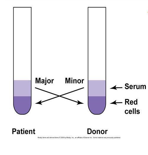 Ghazi2014's tweet photo. -Cross Matching💉🔬
•الاختبار يجرى في حالة طلب نقل دم لمريض
•يجرى فقط على عينات الدم RBCs،Packed Cells
• مبدأ الاختبار: وجود توافق بين المريض والدم المتبرع به بحيث أنه لا يوجد Antibodies في المريض قد تؤدي إلى تفاعلات خطيرة تصل في بعض الأحيان للموت.
•وهو نوعين:
1-major
2-minor https://t.co/GT7l0AEOQV