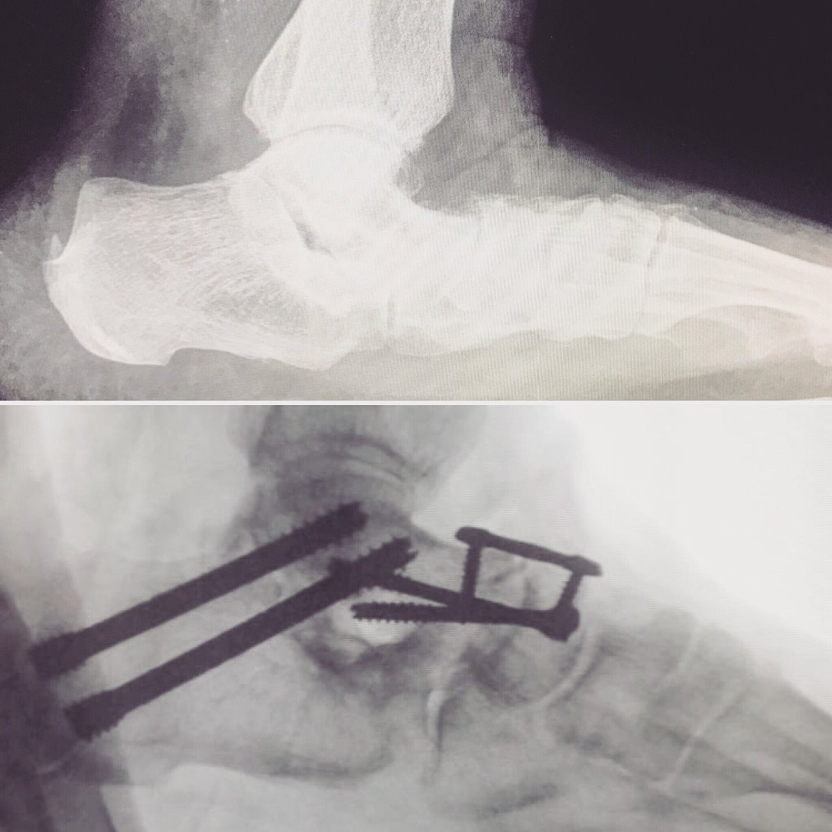 Flat No More #pesplanus #flatfeet #footandanklesurgery #arthrodesis #orthopedics