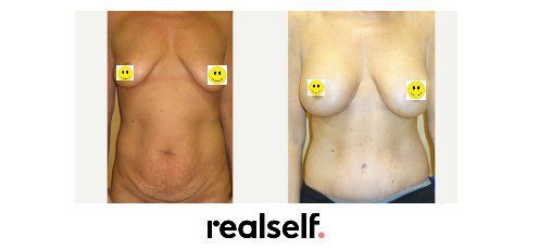 ukaesthetic's tweet photo. Fantastic results following an abdominoplasty and breast augmentation simultaneously. #combinationsurgery https://t.co/kCv6xfnALJ