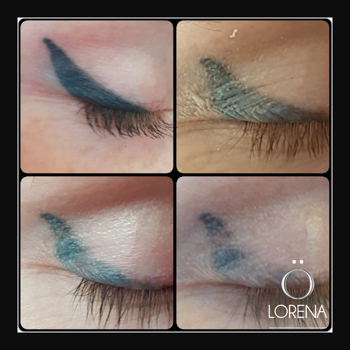 DermaEraze's tweet photo. This eyeliner has had 3 laser sessions and I'm still fighting it! It was so saturated with ink! Training available.   For more information https://t.co/lmpdAN4aSJ #microblading #permanentmakeup  #pmu #permanentmakeupremoval #pmuremoval #pmu #tattoo #tattooremoval https://t.co/FUM9zJQTaC