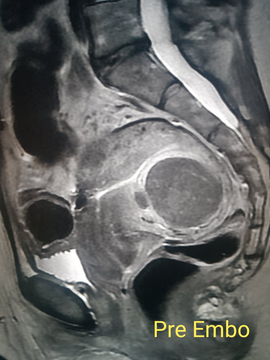 DrAidanShaw's tweet photo. It's #FibroidAwarenessMonth. #UFE is such a good procedure for #uterinefibroids, sparing women from unnecessary #hysterectomy and surgery. It should be offered routinely as it is so effective. In some cases, the fibroids almost disappear entirely @FibroidsNoMore @fibroidsupport https://t.co/9CLiwC56iE
