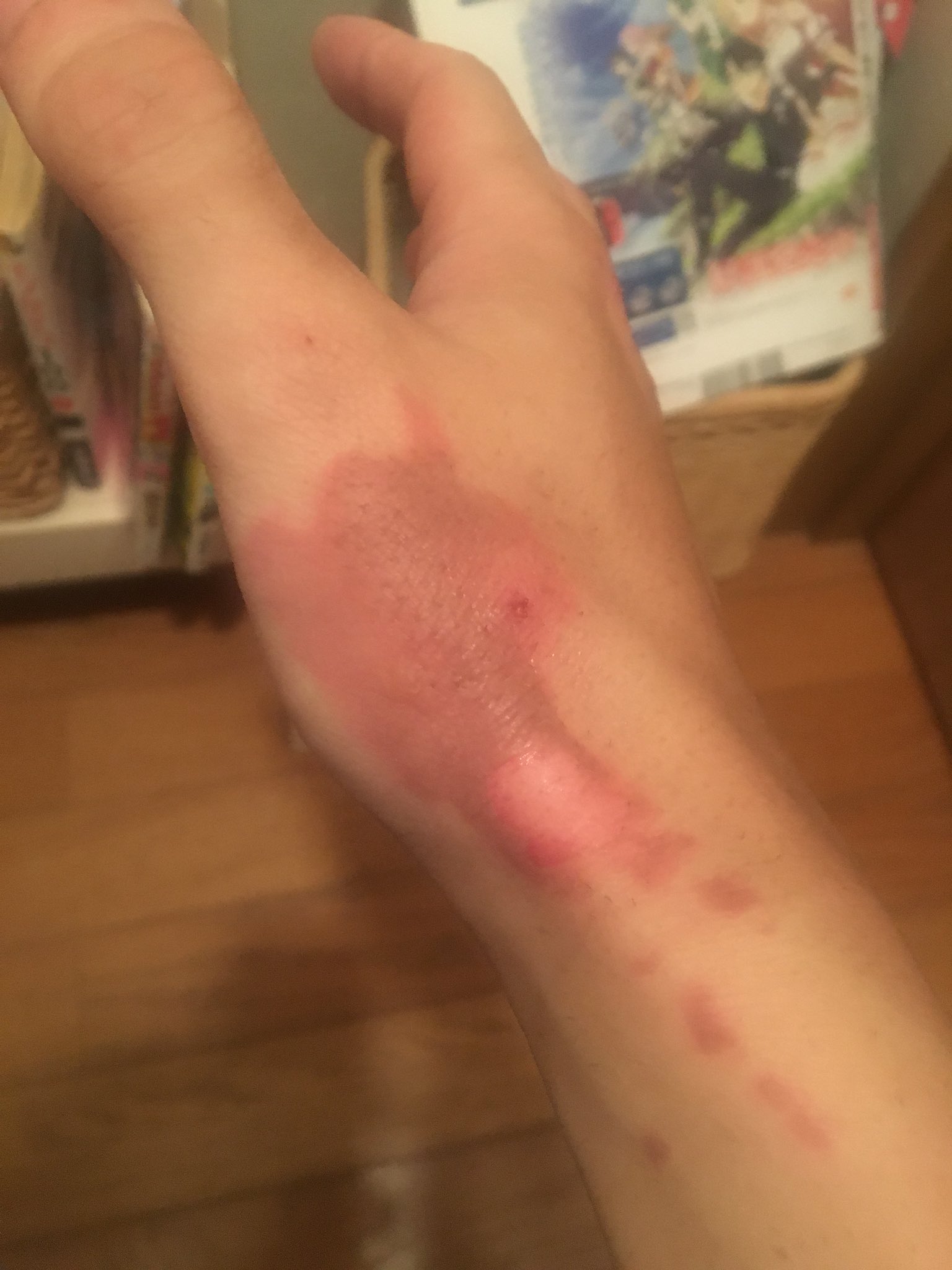 Ras すこし閲覧注意 昨日170度の油かぶった右手の色がヤバめ 料理で大きめの火傷したの初めてや ヒリヒリする T Co 2tu3bjz5dz Twitter