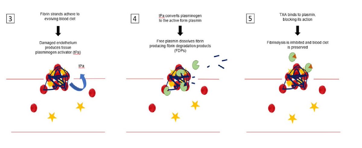 Wfsa Twitterissa New Atotw Published 406 Tranexamic Acid This Tutorial Reviews The Clinical Uses Of Tranexamic Acid Its Mechanism Of Action And Pharmacokinetics Contraindications And Side Effects Read It Here Https T Co Vhfw3mbru6