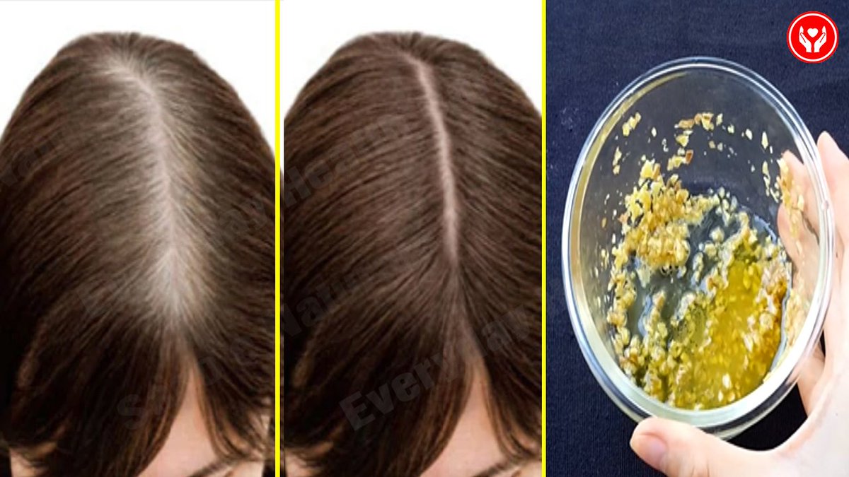 EverydayHeath's tweet photo. Remove Grey Hair Naturally And Stop Hair Loss Only With These 3 Ingredients 
Click on the link for more details
👉https://t.co/D3qDoSD5Ec
#Removegreyhair
#Howtostopgreyhairnaturally
#Everydayhealthcare https://t.co/4Iz2JWLzOL
