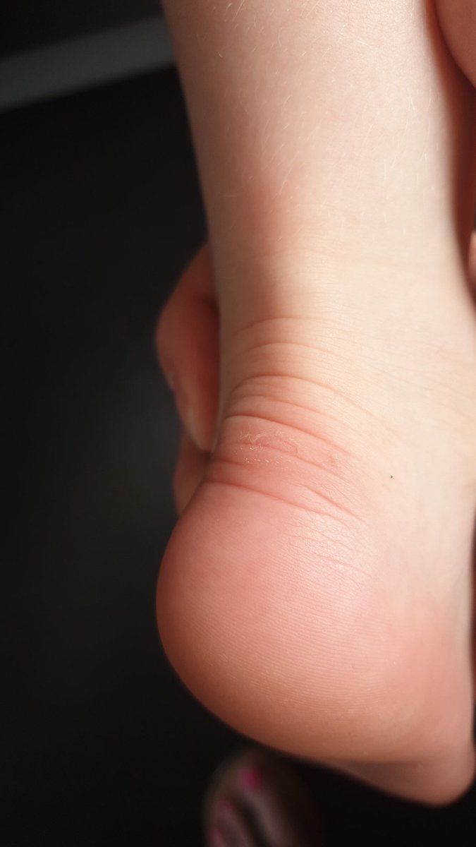 beckydisney's tweet photo. @clarksshoes my daughter has wore her new sandals for 3 minutes &amp; they have rubbed the skin off her heels #ExtremelyDisappointed #UpsetChild https://t.co/IHaj0LXYeA
