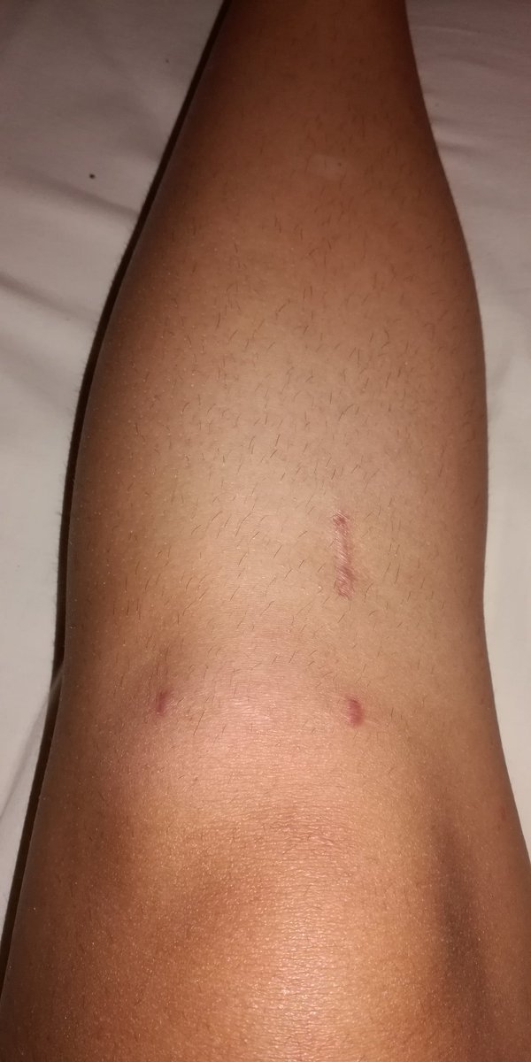 AgaPatathe's tweet photo. Petit aperçu de comment tout va bien et tout progresse à une allure de dingue. La première photo a 7 mois, elle date de juste avant mon opération. La deuxième en a environ 6, 1 mois après l'opération (j'en ai pas fait avant c'était GORE). Et la dernière date de ce soir. https://t.co/C8u3EqBCRW
