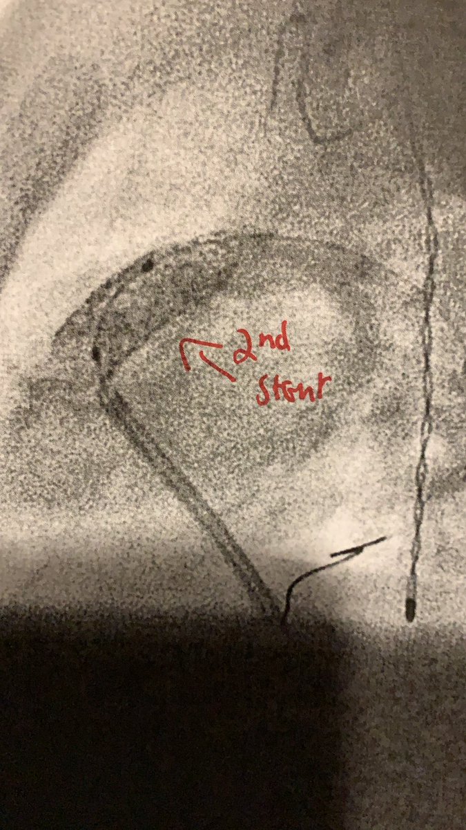 Judah Update - The procedure to place a stint in Judah’s pulmonary artery was successful. He is now recovering. Thank you all for your prayers.