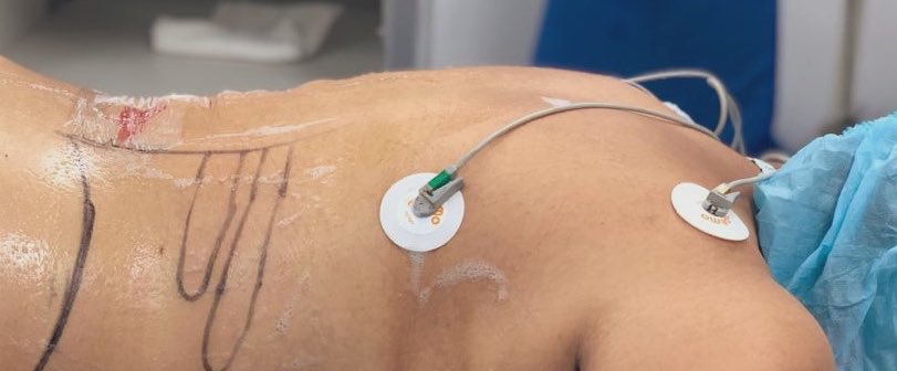 DavidCabrera88's tweet photo. Beginning the Week with 2 #upper pole punctures #PCNL with 14 &amp; 24 sec of fluoroscopy at #Fellowship #Endourology #HRAEB with professor @urobraulio. @cescernesto https://t.co/wOzB9NLIm5