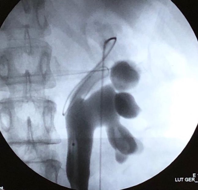 DavidCabrera88's tweet photo. Beginning the Week with 2 #upper pole punctures #PCNL with 14 &amp; 24 sec of fluoroscopy at #Fellowship #Endourology #HRAEB with professor @urobraulio. @cescernesto https://t.co/wOzB9NLIm5