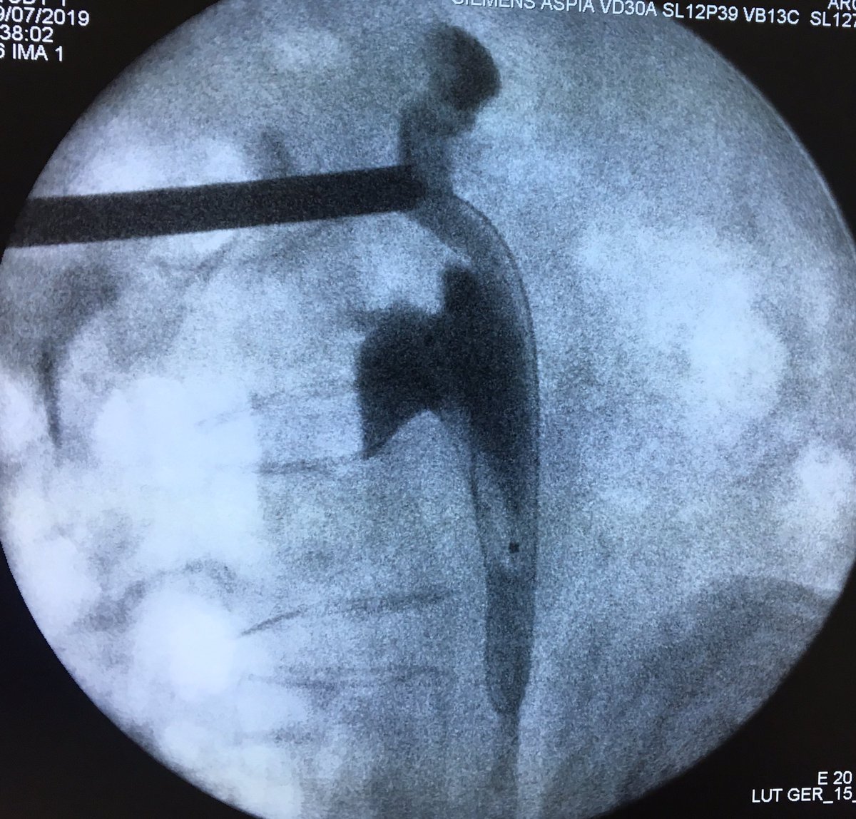 DavidCabrera88's tweet photo. Beginning the Week with 2 #upper pole punctures #PCNL with 14 &amp; 24 sec of fluoroscopy at #Fellowship #Endourology #HRAEB with professor @urobraulio. @cescernesto https://t.co/wOzB9NLIm5