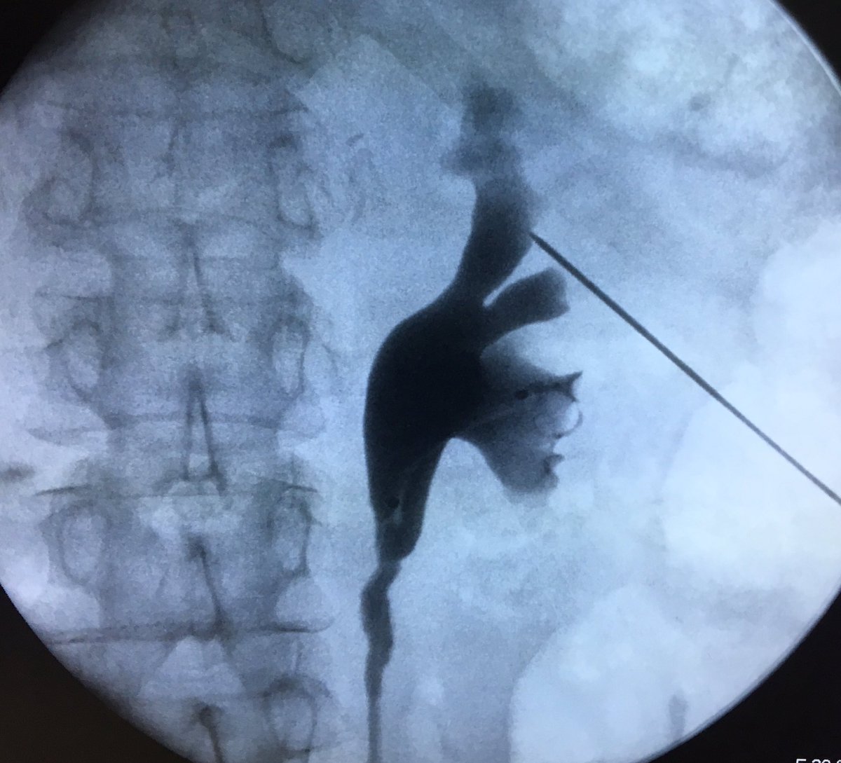 DavidCabrera88's tweet photo. Beginning the Week with 2 #upper pole punctures #PCNL with 14 &amp; 24 sec of fluoroscopy at #Fellowship #Endourology #HRAEB with professor @urobraulio. @cescernesto https://t.co/wOzB9NLIm5