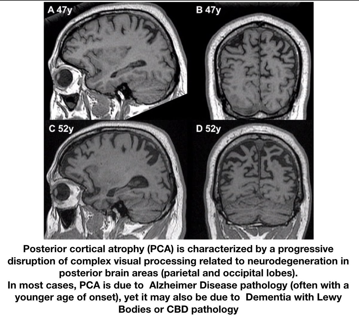 Vicente Martin On Twitter Foamrad Corticobasal Degeneration