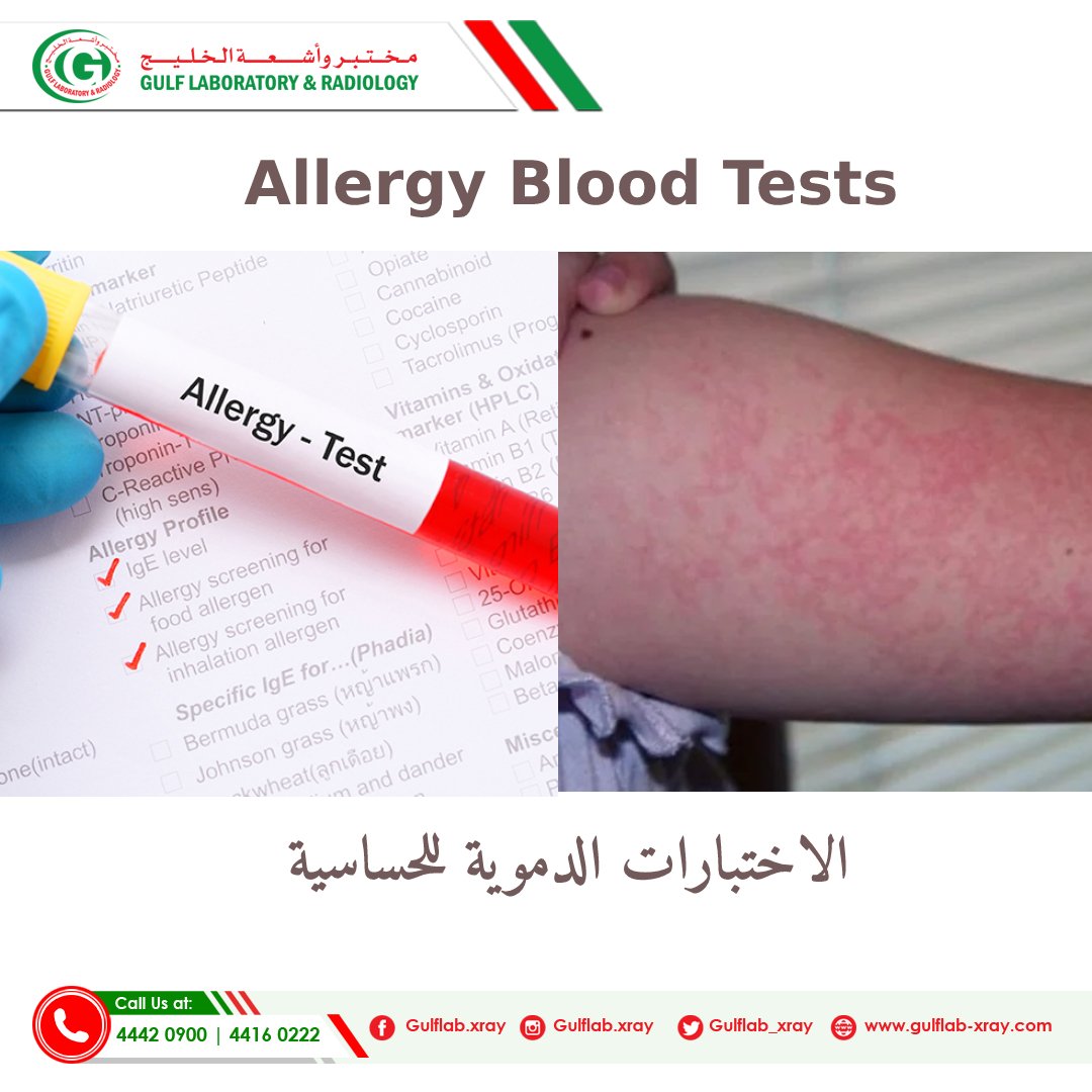 Allergy Blood Test allergy-blood-test