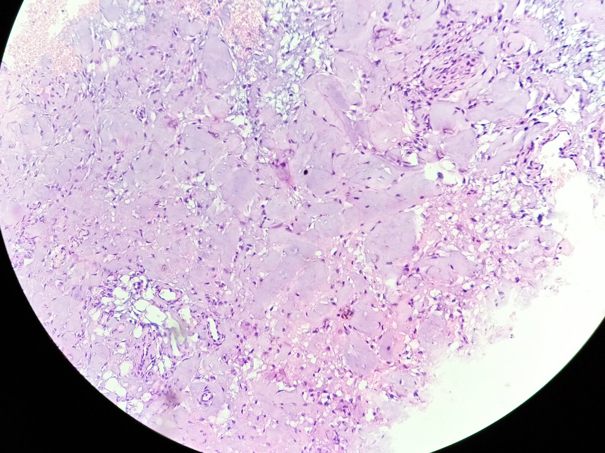 deedee2984's tweet photo. Hello PathTweeples. What say you about this gluteal mass biopsy from a 7year/M. #bstpath #pedipath
@JMGardnerMD @DrRolaAli @D4L14H @DrGeeONE @AnnieMcLeanDMD @tralimiguel @nusrat_xahra @AyshaMubeen86 @ariella8 @TheKarenPinto @kriyer68 https://t.co/yzWwqN5xhw