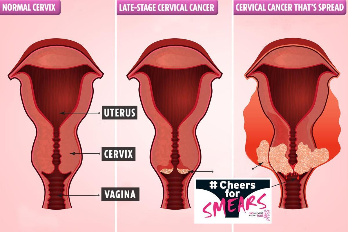 Fabulousmag's tweet photo. The 5 early signs you could have cervical cancer #CheersForSmears https://t.co/es5HitE2DX https://t.co/CZ0kVhlNFV
