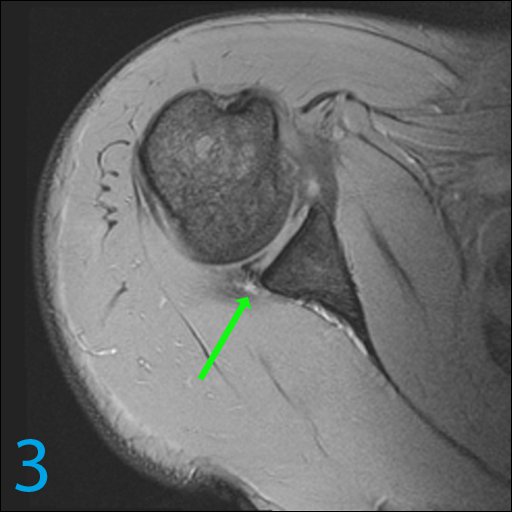 DrPomeranz's tweet photo. Today, we provide you with key images. Using only these images, see if you can find the MOST LIKELY diagnosis in the poll below!

Hx: 33-year-old weight lifter with anterior shoulder pain and popping

#Radiology #ShoulderMRI

For MORE cases click here: https://t.co/chXwvX9pUc https://t.co/ykNakbtr9r