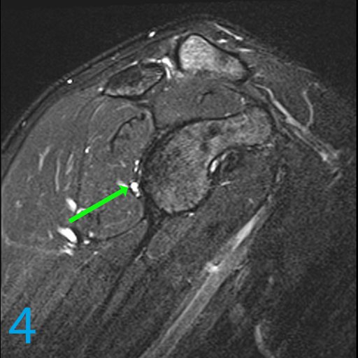 DrPomeranz's tweet photo. Today, we provide you with key images. Using only these images, see if you can find the MOST LIKELY diagnosis in the poll below!

Hx: 33-year-old weight lifter with anterior shoulder pain and popping

#Radiology #ShoulderMRI

For MORE cases click here: https://t.co/chXwvX9pUc https://t.co/ykNakbtr9r