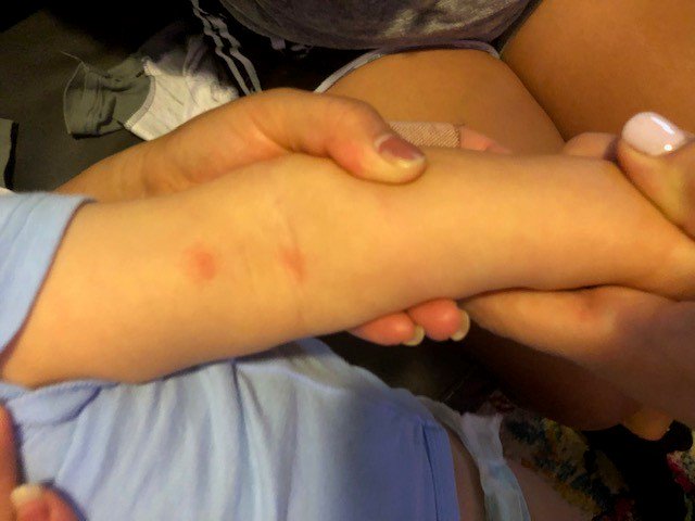 SPerkins21's tweet photo. BED BUGS!! @HamptonByHilton Milwaukee West. We stayed 2 nights &amp; left w/ Bed Bugs. 4AM Sunday morning (getting ready 2 check out) I found a bug crawling on my leg.I swatted it off &amp; look up at the ceiling and there was another one.I took pictures &amp;showed front desk. https://t.co/T4fFrJ8L1i