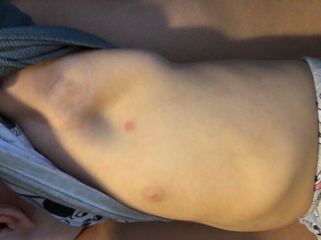 SPerkins21's tweet photo. BED BUGS!! @HamptonByHilton Milwaukee West. We stayed 2 nights &amp; left w/ Bed Bugs. 4AM Sunday morning (getting ready 2 check out) I found a bug crawling on my leg.I swatted it off &amp; look up at the ceiling and there was another one.I took pictures &amp;showed front desk. https://t.co/T4fFrJ8L1i