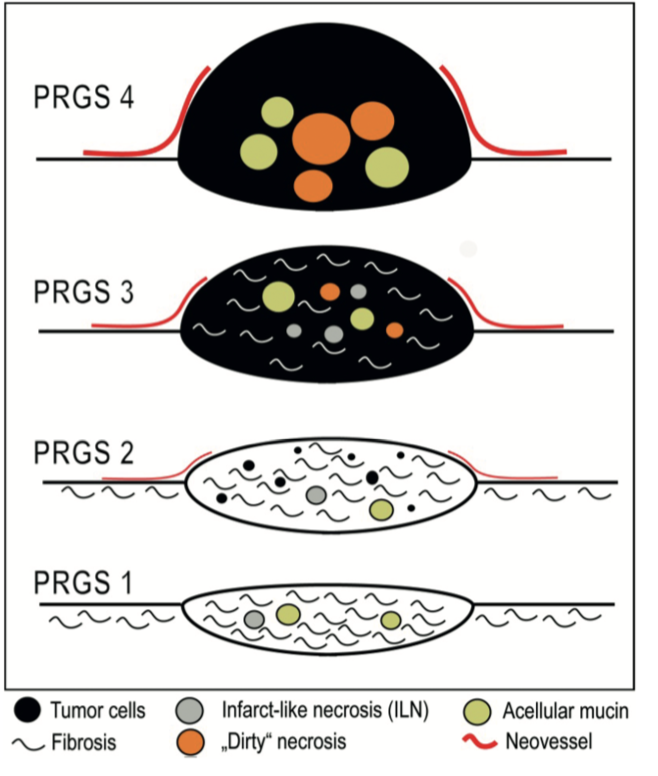 polom_karol's tweet photo. #peritoneal metastases objective assessment of therapy response after #multimodal treatment Peritoneal #Regression Grading Score (#PRGS) #PIPAC #HIPEC #pleuraandperitoenum @DeGruyterOA @oliviawriting @DeliaCortesGuir @SPeritoneum https://t.co/PATZUqs0Qe https://t.co/f6WYDrA4jG