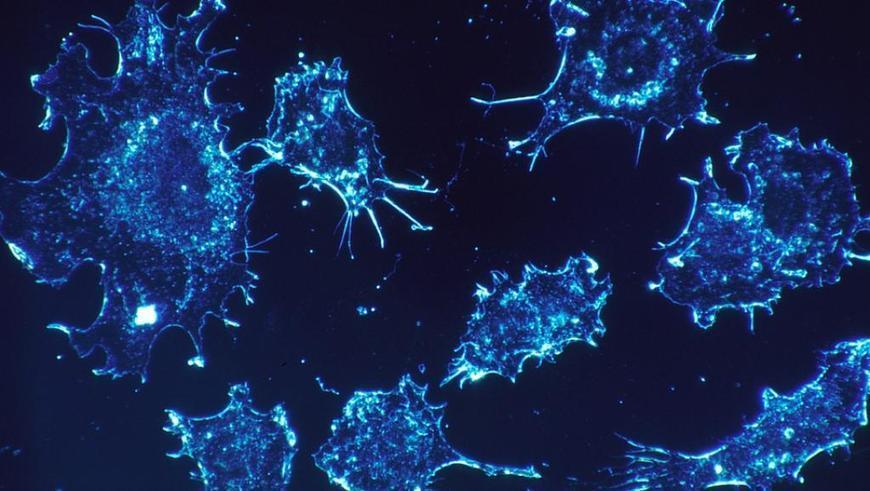 radiotherapiefr's tweet photo. Pourquoi et comment changer de regard sur le #cancer ? #hcsmeufr #tumeur @rfi https://t.co/Uf25Yj79JV https://t.co/Cry5u3iXre