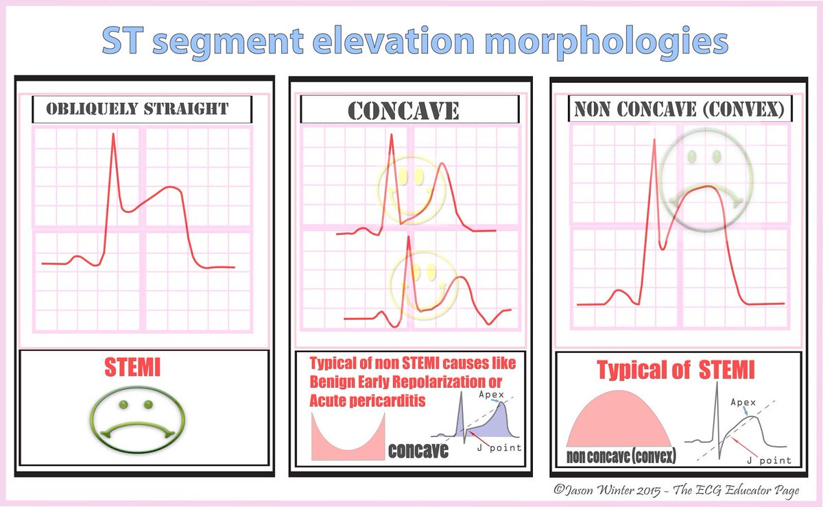 To differentiate Benign Early Repolarization from STEMI, get serial ...