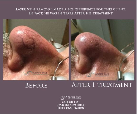 AFaceAntiAging's tweet photo. Laser Vein Removal gets rid of spider veins. This client saw instant results before leaving our clinic #laserveinremoval #spiderveinremoval #spiderveinsonfaceremoval #spiderveinremovalbeforeandafter #laserspiderveinremovalbeforeandafter #laserspiderveinremovalhowlongtoseeresults https://t.co/1W2jybk9EI