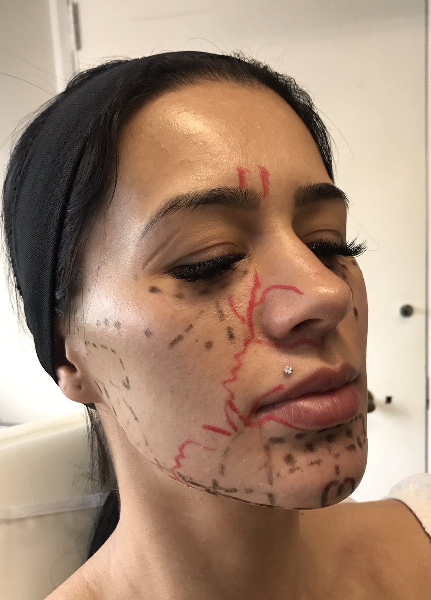 MissBalaratnam's tweet photo. Enjoyed a day of @Allergan #Medical #Institute training in clinic today on the use of the latest #JuvedermVolux #dermalfillers for #chin and #jawline #contouring #aesthetics #naturalresults #Juvedermuk #Juvedermit #BeautyDecoded #MDCodes Thank you to my colleagues for joining me https://t.co/c3woPALAVB