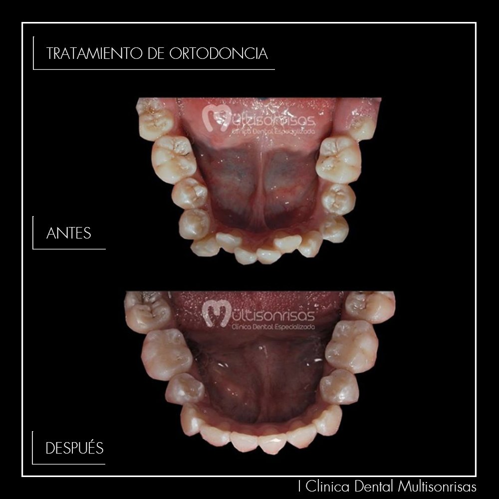 multisonrisasmx's tweet photo. Este caso un antes y después, debido al apiñamiento o dientes chuecos fue necesario extraer 2 premolares. ¿Notas el cambio? 
#sonrisa #riete #risas #dientes #odontología #mexico #odontologo #miercoles #multisonrisas #multisonrie #ortodoncia #10jul #cdmxlife #cdmx #julio https://t.co/tZ8VmjUjYd