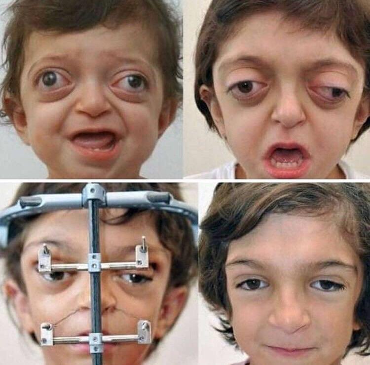 ThomasFrey's tweet photo. This is amazing! #Facial #reconstruction on a child with #Crouzon #Syndrome! https://t.co/B09A0tKdT8 #keynotespeaker #futuretrends https://t.co/aYCO33OhOa