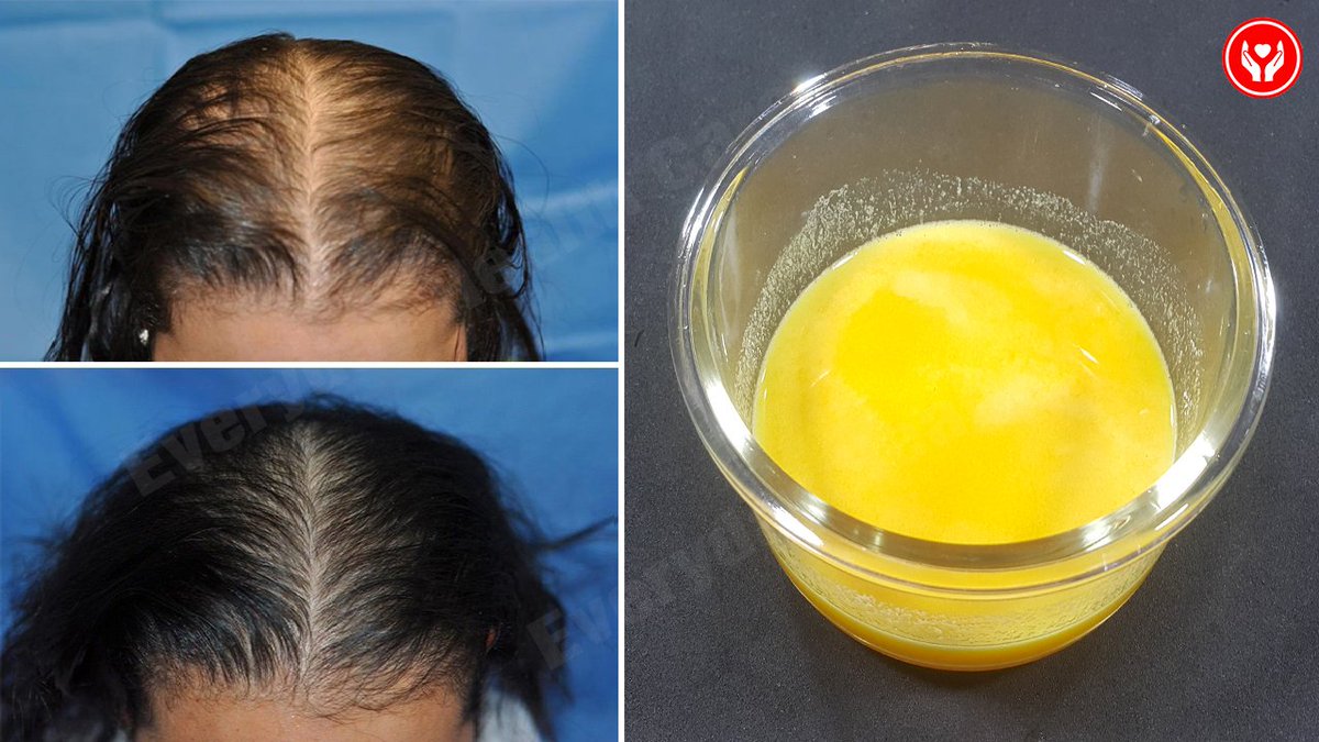 EverydayHeath's tweet photo. How To Stop Hair Loss Naturally and Eliminate Dandruff With Only These 2 Ingredients
Click the following link
👉https://t.co/oXlpAhaXKR
#HowToStopHairLoss
#StopHairLossNaturally
#EliminatingDandruffNaturally
#Everydayhealthcare https://t.co/WXd2IX864k
