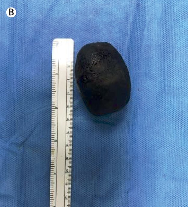 TheLancet's tweet photo. The diagnosis was #BouveretsSyndrome, an uncommon presentation of obstruction of the gastric outlet &amp; a rare form of gallstone ileus. It is caused by a gallstone passing through a cholecystoduodenal fistula, impacting the duodenal cap &amp; causing obstruction https://t.co/UWttAOQMdv https://t.co/rpQmGbC41B