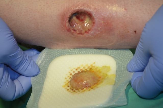 Coloplast_WCare's tweet photo. Wound quiz time!
Dressings w/ #OptimalAbsorption & #ExudateManagement reduce healing time by... A) creating a wet wound environment, B) preventing the stimulation of granulation tissue, C) allowing for fewer dressing changes.
A, B or C? We'll share the correct answer tomorrow! https://t.co/RP2NBrBtJA
