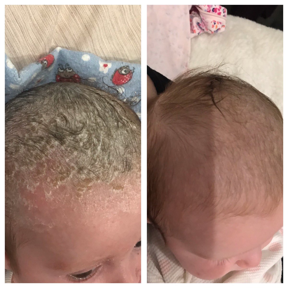moogoo cradle cap
