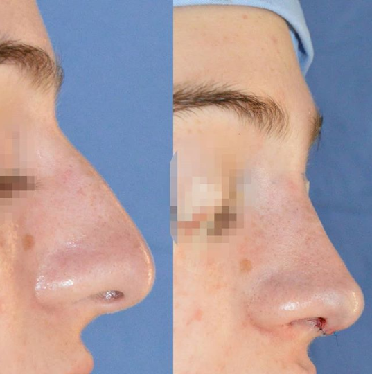VisitandCare's tweet image. Immediate result of #rhinoplasty after removal of the hump using #piezosurgery , and improving the shape and definition of the tip
bit.ly/2VZoknx

#drsamerbassilios #rhinoplastylebanon #plasticsurgerylebanon #plasticsurgery #rhinoplastyexpert #rhinoplastybeforeandafter