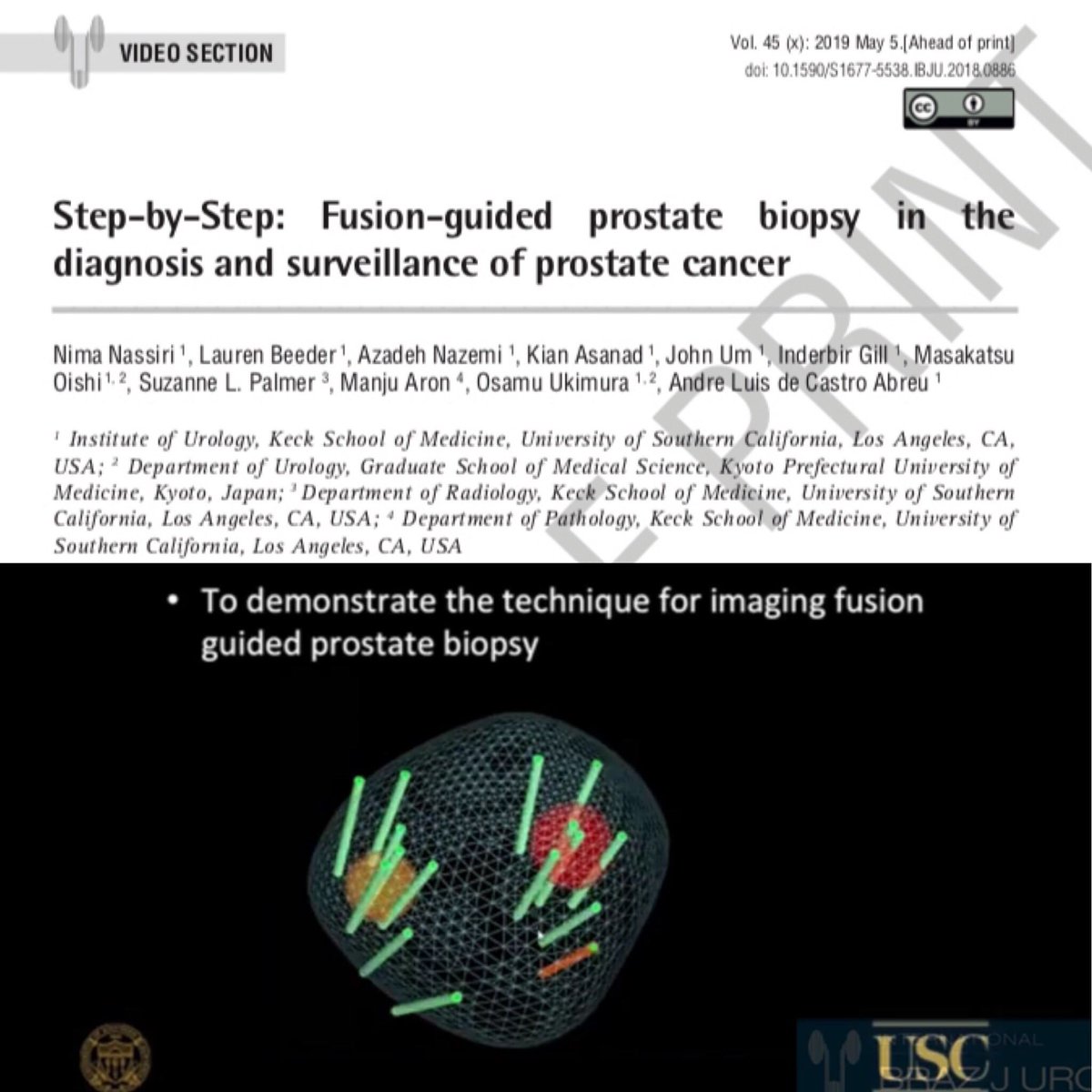 This is an educational video that provides our step-by-step technique for fusion-guided biopsy for prostate cancer diagnosis and surveillance.
@USC_Urology 
#MRIfirst
#prostatecancer
#prostatebiopsy
#MRITRUSfusionbiopsy
#MRI

intbrazjurol.com.br/video-section/…