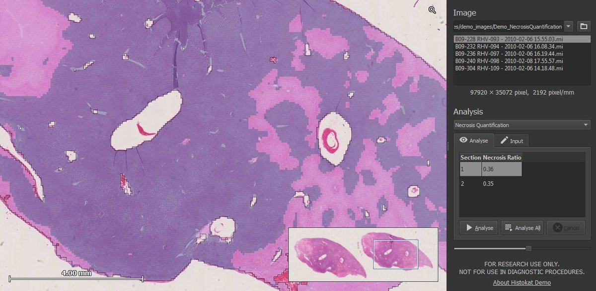 FraunhoferMEVIS's tweet photo. #MachineLearning und #DigitalePathologie: darum ging es heute bei unserem Workshop bei der SommerAkademie der @UniBremen. https://t.co/YSWaWlG5zr #KI #ComputationalPathology #DigitaleMedizin #whatsnext https://t.co/st63EpHYJe
